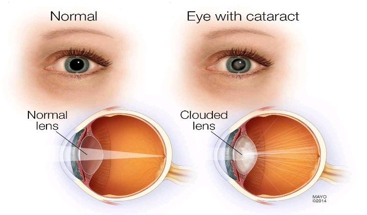 Very effective Eye treatment against  Cataracts, Myopia etc.