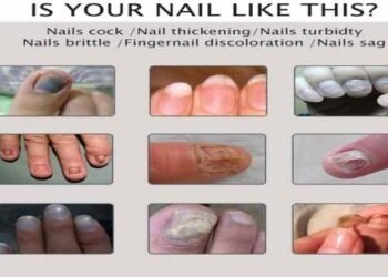 How to cure Nail fungus