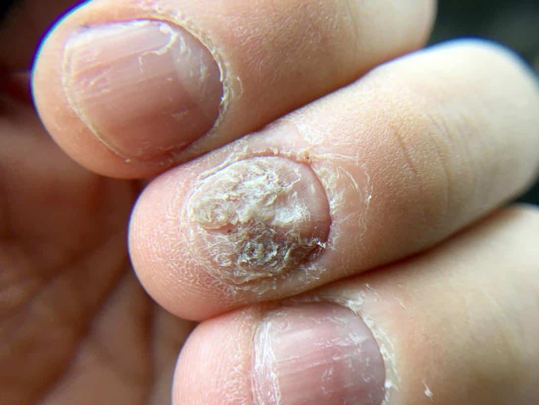 How to cure Nail fungus
