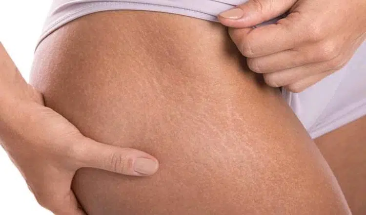 Stretch marks treatment are reddish