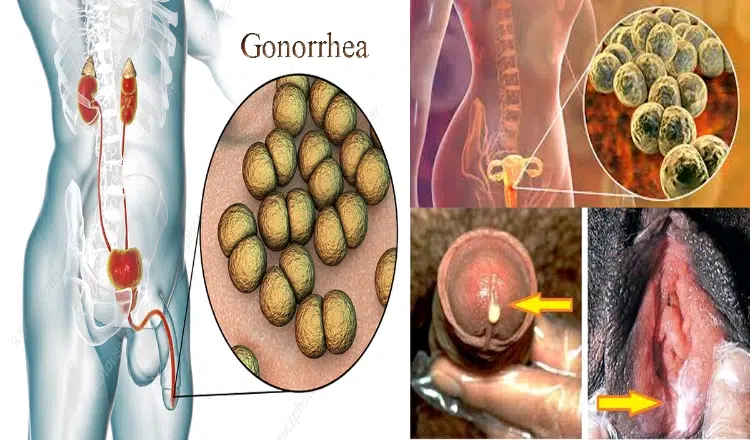Remedy to cure Gonorrhea in men and women