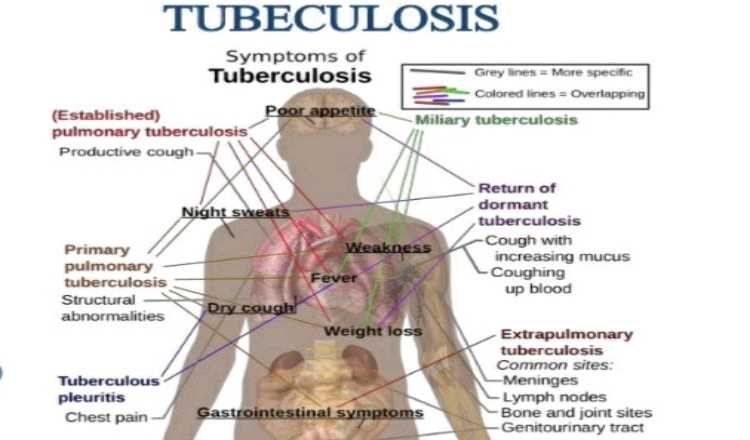 How to treat tuberculosis naturally