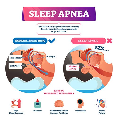 How To Stop Snoring at night: Treat snoring naturally: How to stop Snoring Naturally
