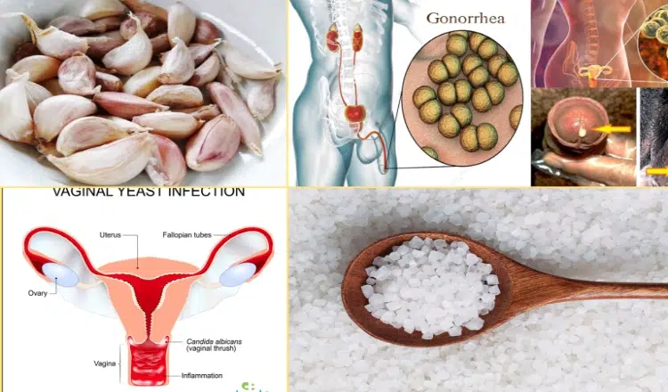 NATURAL TREATMENTS OF STDS, YEAST INFECTION AND GONORRHEA