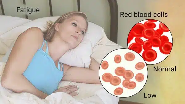 Causes and treatment of Anemia (lack of blood)