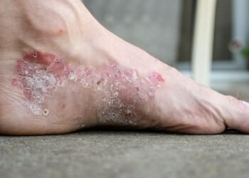 Natural Remedies for Eczema: Herbal Solutions for Itchy Skin