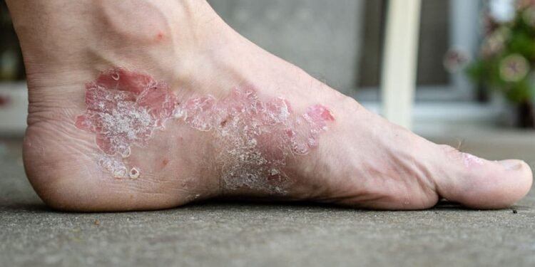 Natural Remedies for Eczema: Herbal Solutions for Itchy Skin