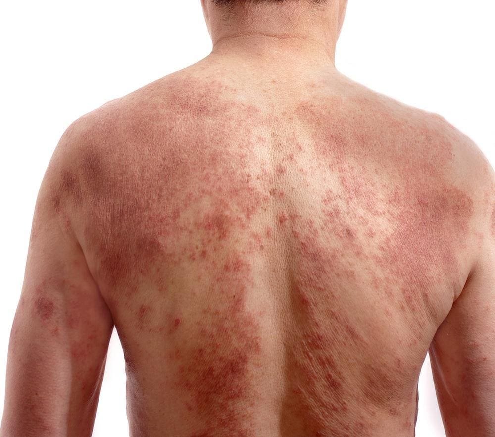 Natural Remedies for Eczema: Herbal Solutions for Itchy Skin