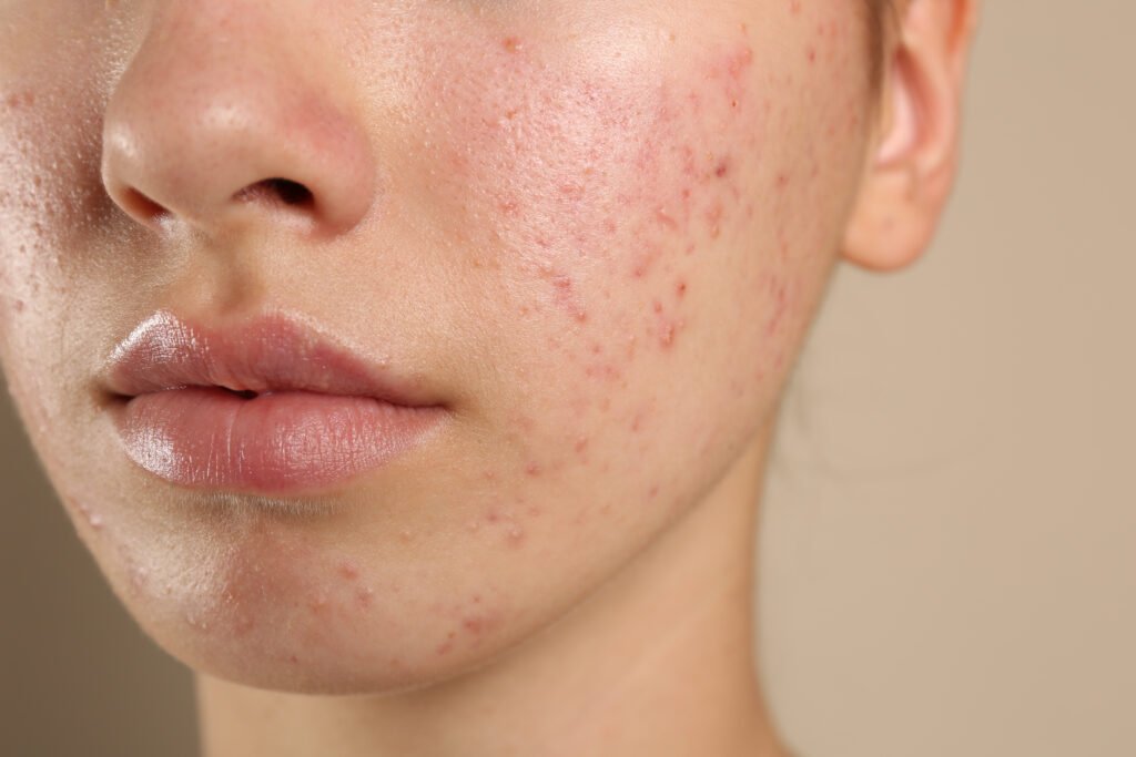 acne